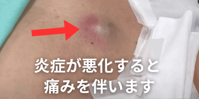 皮膚科で「取れない」と言われた粉瘤、本当に諦めるしかないの?断られる理由とその対処法を説明 - 北海道皮膚のできものと粉瘤クリニック古林形成 ...
