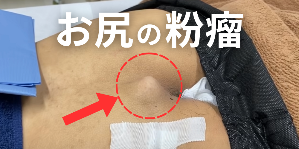 おしりの粉瘤は自然に治らない。痛みや腫れがある人は早めに専門医へ - 北海道皮膚のできものと粉瘤クリニック古林形成外科 札幌院|中央区大通にて ...