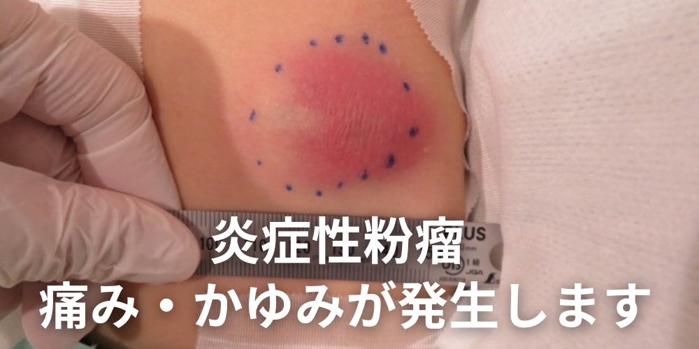 背中にできる痛い粉瘤（アテローム）の特徴と主な症状を解説 - 北海道皮膚のできものと粉瘤クリニック古林形成外科 札幌院｜中央区大通にて皮膚悩み ...