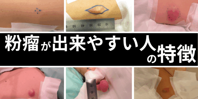 おしりの粉瘤は自然に治らない。痛みや腫れがある人は早めに専門医へ - 北海道皮膚のできものと粉瘤クリニック古林形成外科 札幌院|中央区大通にて ...