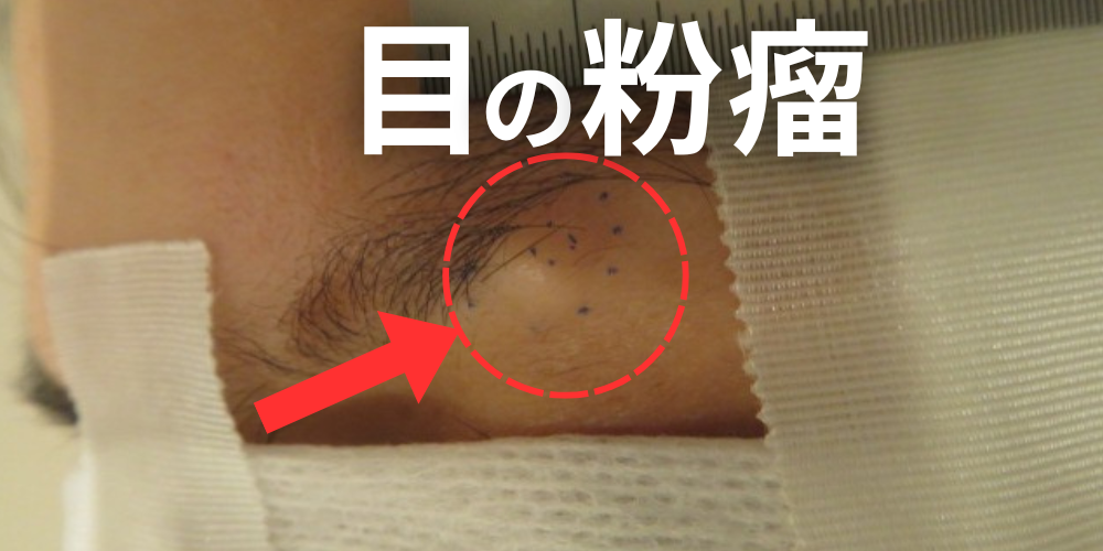 おしりの粉瘤は自然に治らない。痛みや腫れがある人は早めに専門医へ - 北海道皮膚のできものと粉瘤クリニック古林形成外科 札幌院|中央区大通にて ...