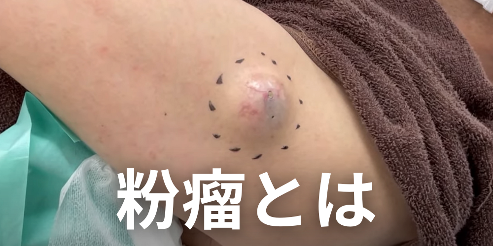 【症例画像】粉瘤が出来やすい部位・場所の特徴と原因を形成外科専門医が解説 - 北海道皮膚のできものと粉瘤クリニック古林形成外科 札幌院|中央区 ...