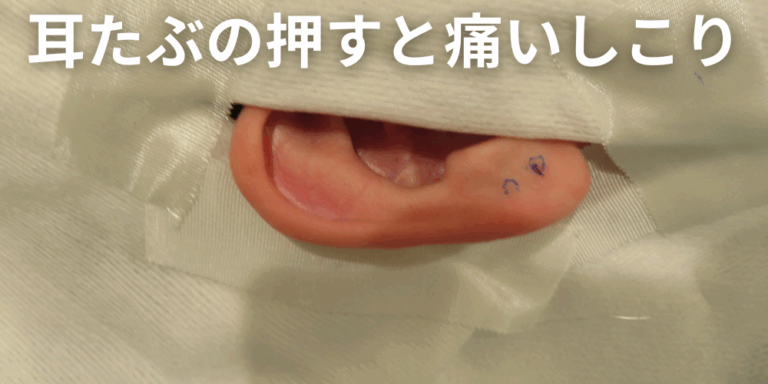 押すと痛い耳たぶのしこりが考えられる病気を形成外科専門医が解説 - 北海道皮膚のできものと粉瘤クリニック古林形成外科 札幌院|中央区大通にて ...