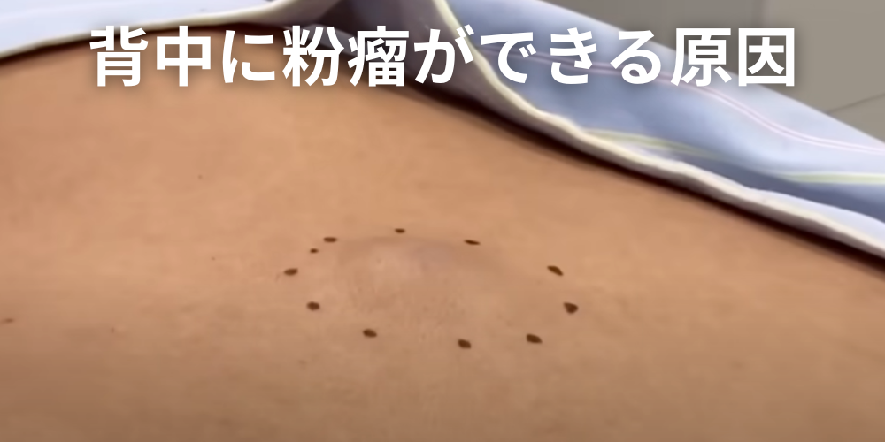 おしりの粉瘤は自然に治らない。痛みや腫れがある人は早めに専門医へ - 北海道皮膚のできものと粉瘤クリニック古林形成外科 札幌院|中央区大通にて ...