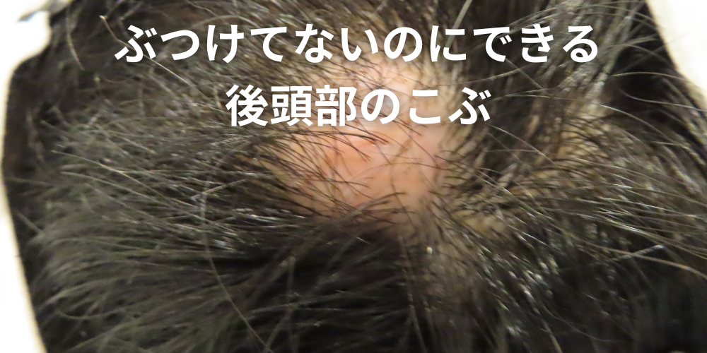 頭にできた“できもの”の正体とは?考えられる病気と受診すべき診療科を形成外科医が解説 - 北海道皮膚のできものと粉瘤クリニック古林形成外科 ...