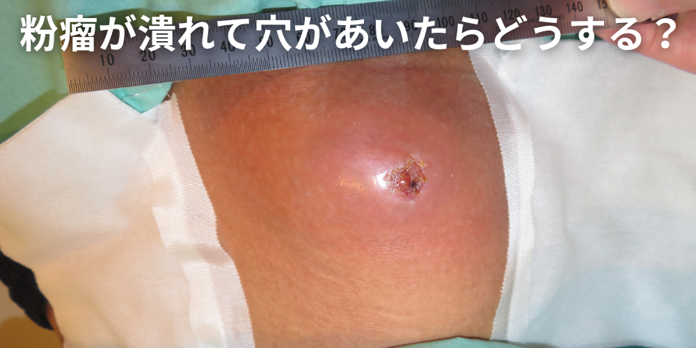 粉瘤が潰れて穴があいたらどうする？正しい対処法と受診すべき診療科を 